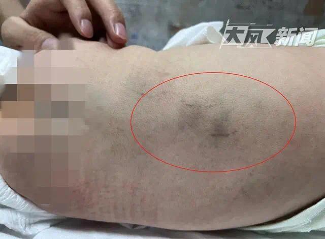 婴儿背部有一大片淤青