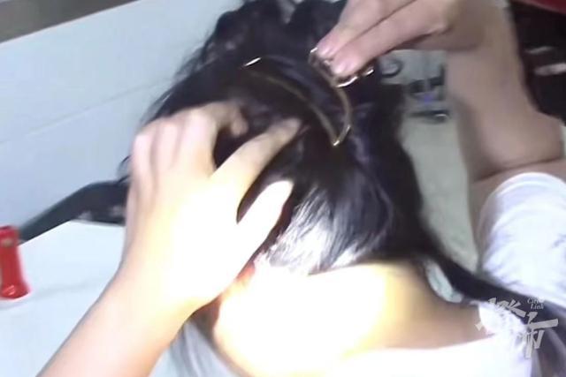 女子戴鲨鱼发夹晕倒后致头部骨折