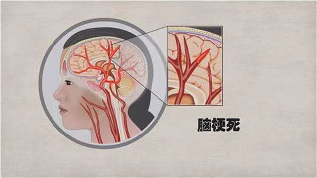 如何能快速识别脑梗死