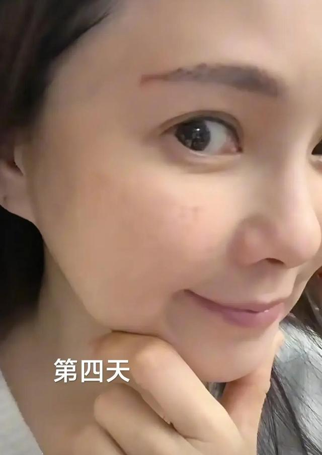 56岁伊能静晒韩国医美照 感叹：太痛了