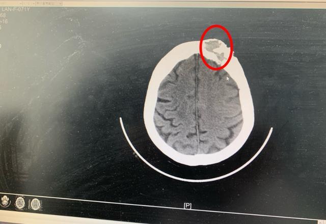 女子额头长包以为是磕到的，就医确诊颅骨内脑膜瘤