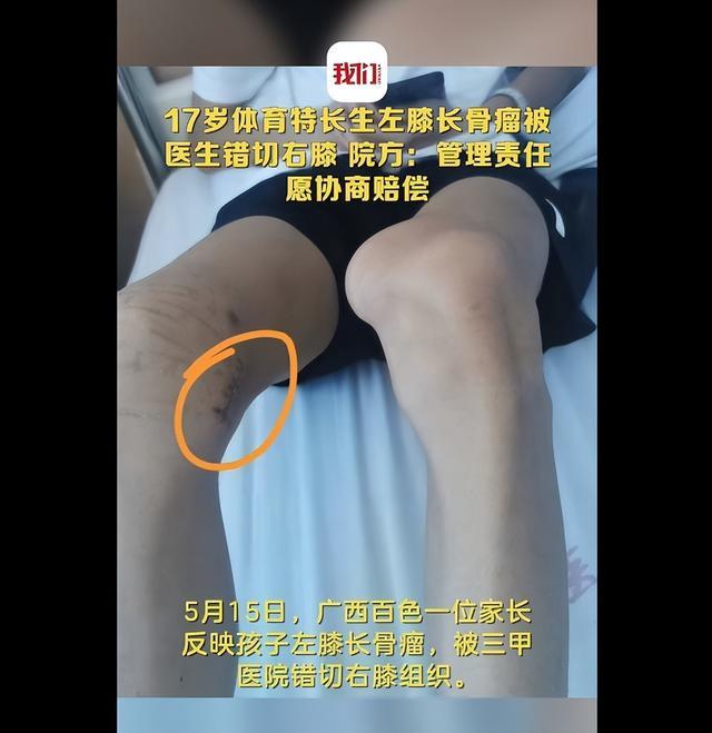 体育生左膝长骨瘤医生错切右膝 医院：愿协商赔偿