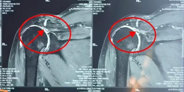 老人肩膀疼痛确诊右肩巨大肩袖撕裂
