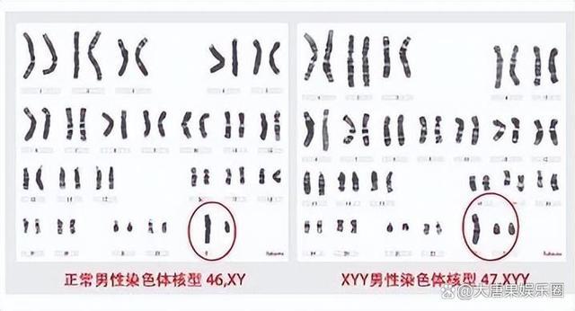 胎儿检出超雄的孕妇已打胎 超雄风险下的艰难抉择