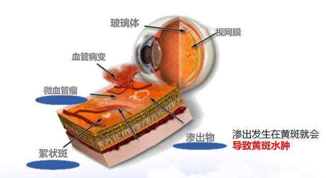 警惕！血糖高可导致糖尿病性黄斑水肿-第1张-科技-传卓科技
