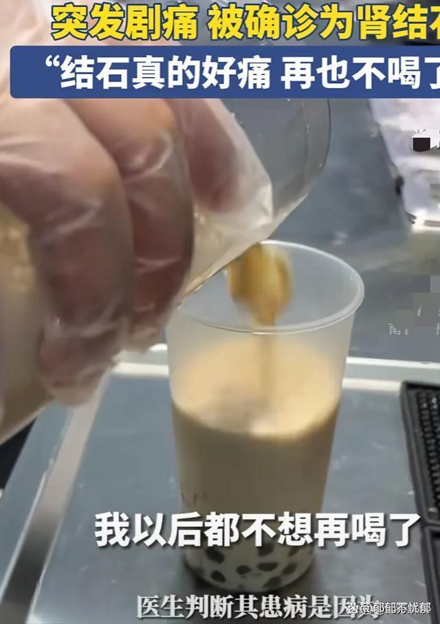 女子因喝奶茶过于频繁 被确认为肾结石 奶茶爱好者的警钟