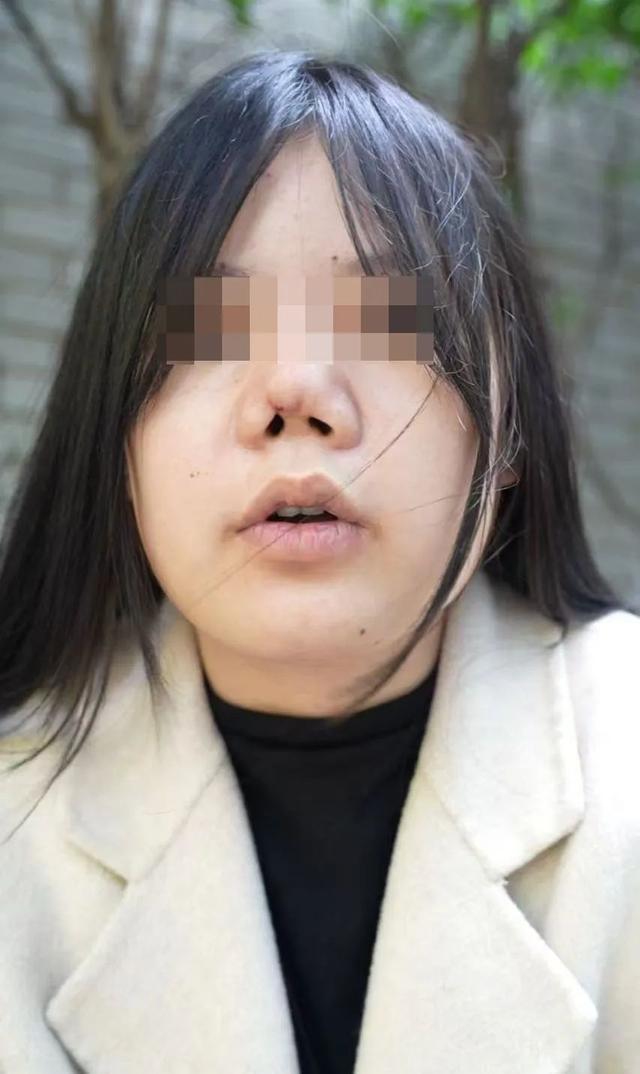 美女隆鼻后像