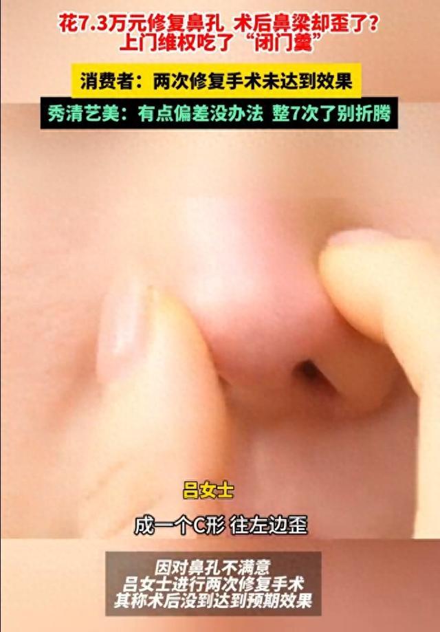 女子花数万修复鼻孔却被弄歪鼻梁 美容变“毁容”