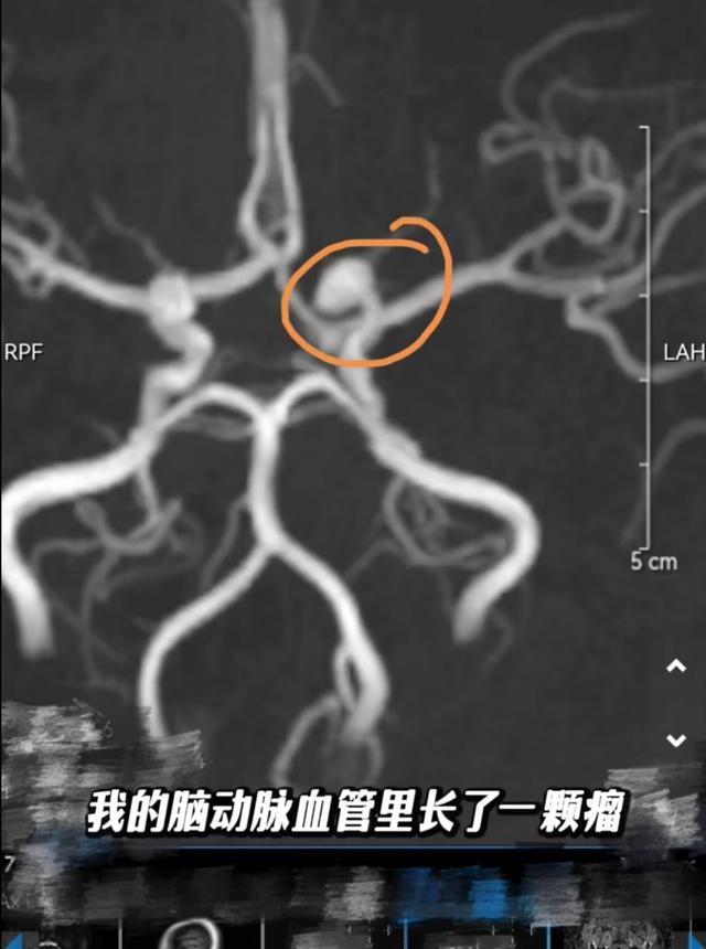 演員孫銥哽咽自曝二胎沒(méi)了 腦內(nèi)“定時(shí)炸彈”被發(fā)現(xiàn)