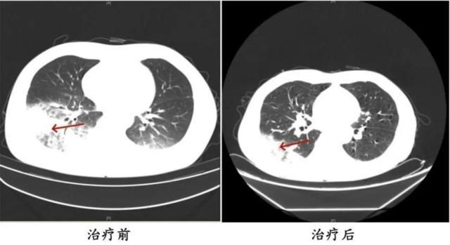 吹了3天空調 男子左肺“白”了一半！ 警惕軍團菌感染