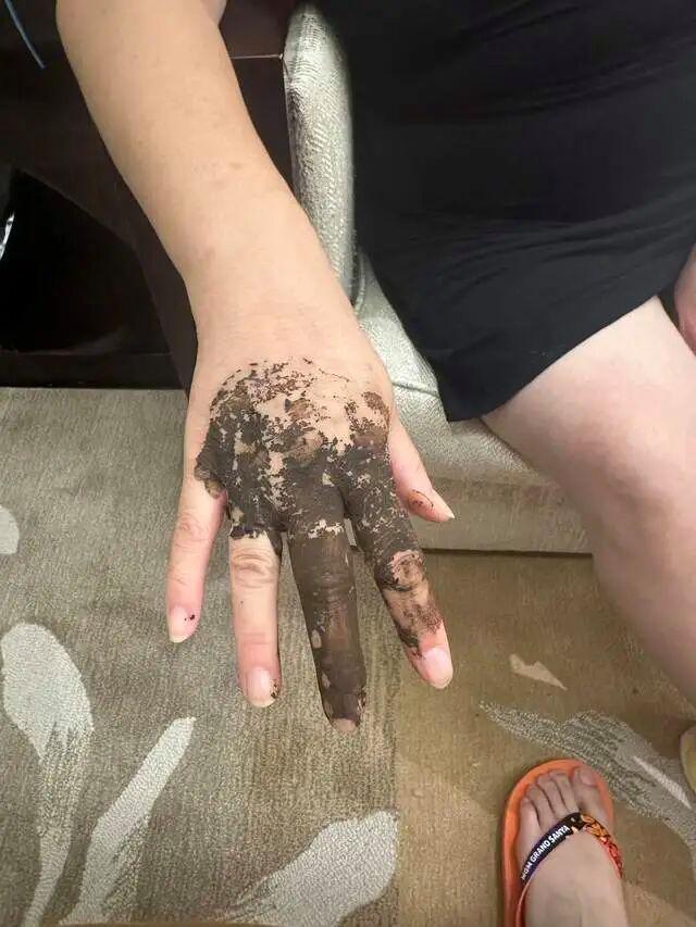 1岁孩子住美高梅酒店被毒虫咬伤 酒店态度强硬引发争议