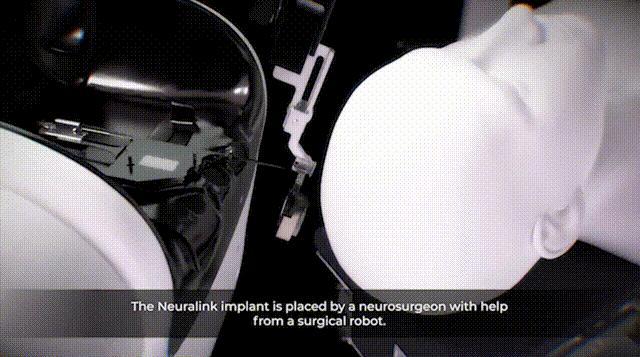 馬斯克“開顱插針”首破1.5秒 手術(shù)機(jī)器人效率驚人