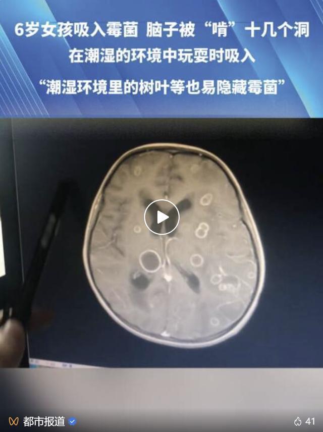 女童发烧17天脑子险被霉菌“啃”空