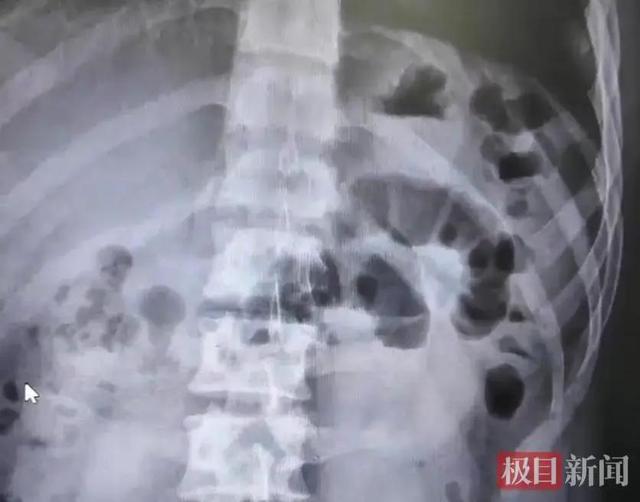 男子吃2斤胡萝卜丝得肠梗阻 效仿冠军致病