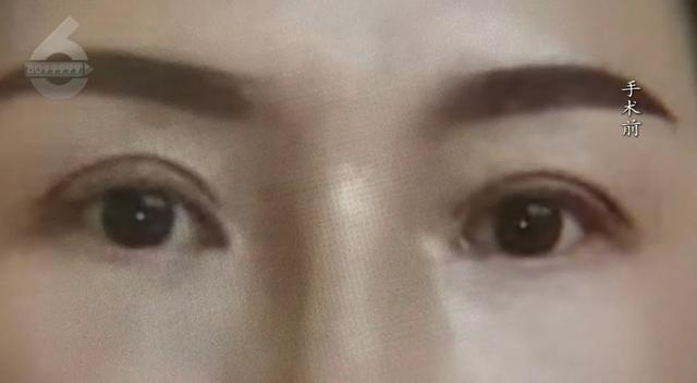 4万整形还不如术前 院方回应 顾客不满效果要求赔偿