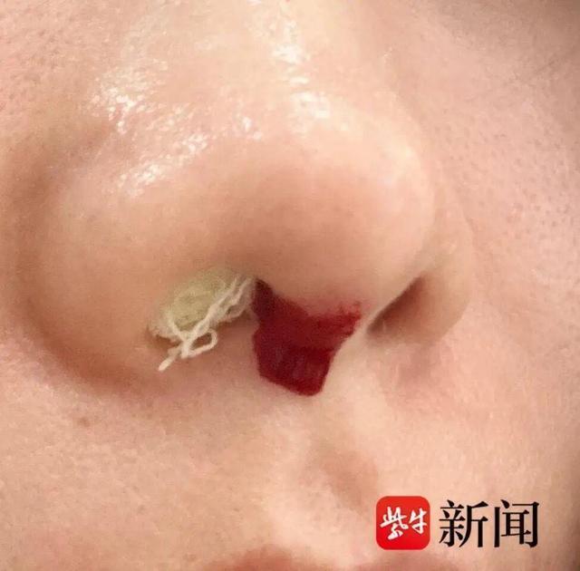 女子花2萬(wàn)隆鼻 玻尿酸從鼻孔流出 醫(yī)美機(jī)構(gòu)賠償數(shù)萬(wàn)元