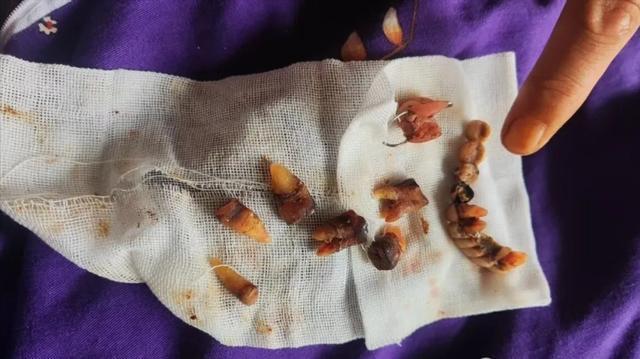 心梗老人看牙被全口拔光 余额被刷光 口腔医院乱象引关注