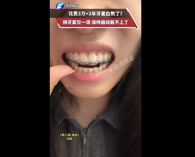 女子矫正牙齿一周没戴保持器就反弹