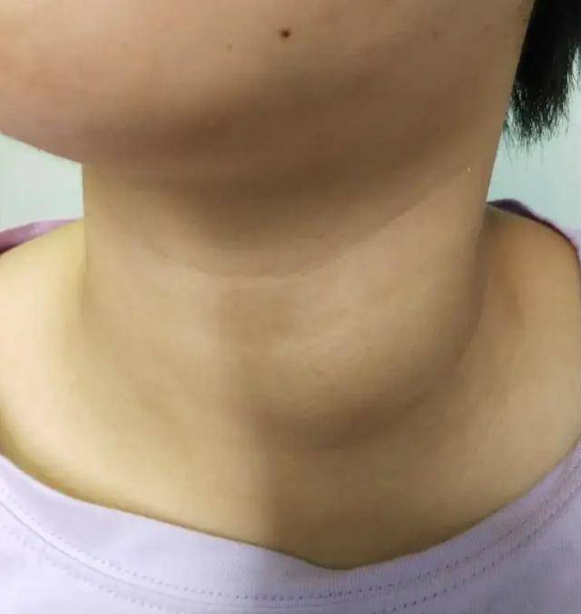 甲状腺最怕的坏习惯有哪些？