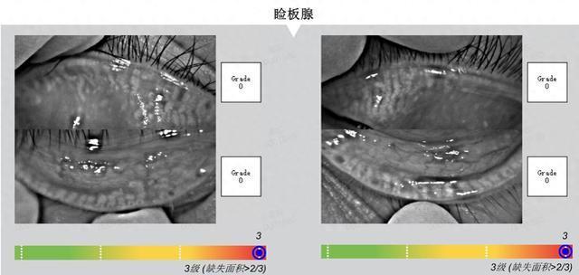 27岁小伙眼睛70岁：过度用眼熬夜
