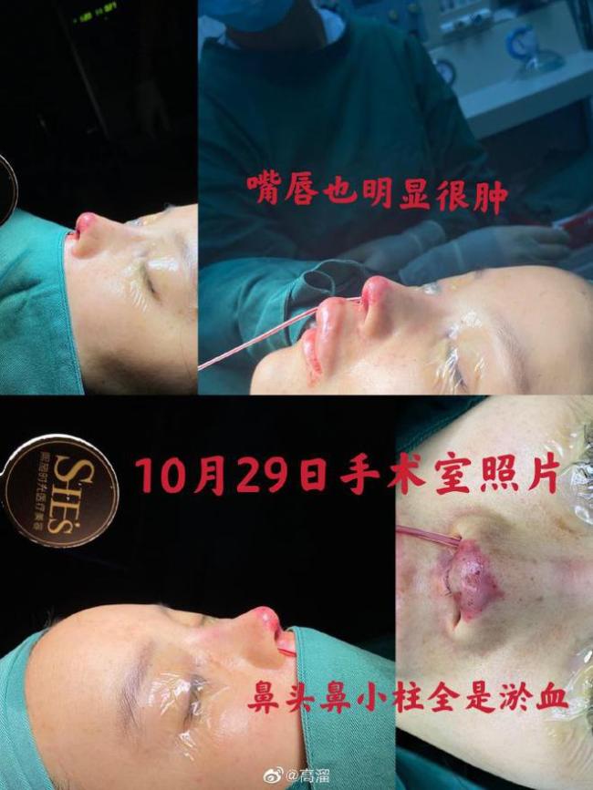 女演员高溜整容失败鼻子坏死 并面临200万违约赔偿