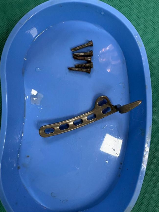 陈哲远手术取钢钉后首亮相 报吉利晒钢钉