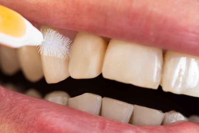 牙齿矫正期间想控制牙菌斑 牢记这些方法