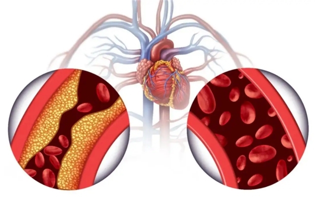 了解低密度脂蛋白高吃什么药，精准选药，让“坏胆固醇”不越界