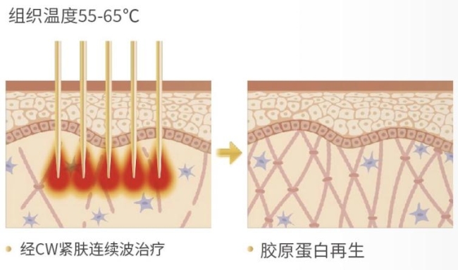 皮肤怎样“先修复后抗衰”？Sylfirm X黑曜双波：从基底膜带开始