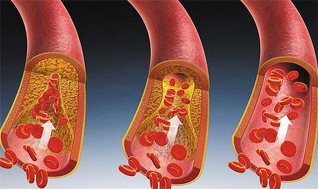 不想血管被“糊住”，了解高血脂怎么治疗，做好应对策略是关键