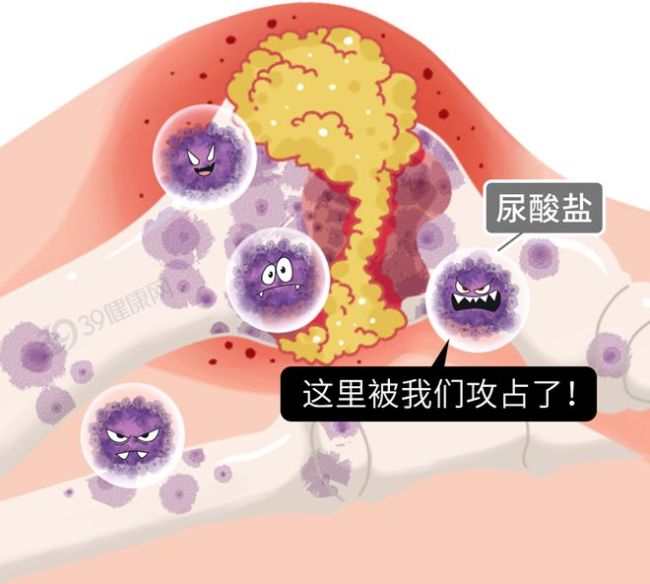 3种蔬菜嘌呤比肉还高，堪称“尿酸炸弹”