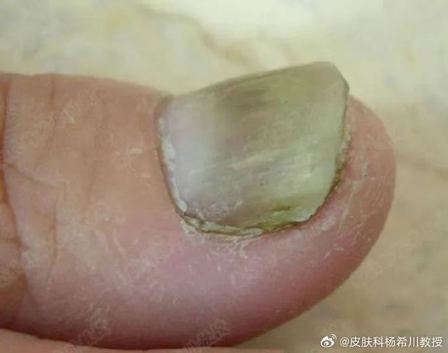你以为的灰指甲，可能不是灰指甲