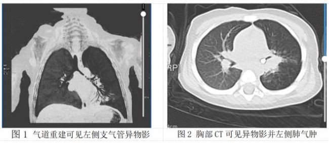 春节儿童气道异物防护指南，家长必看！