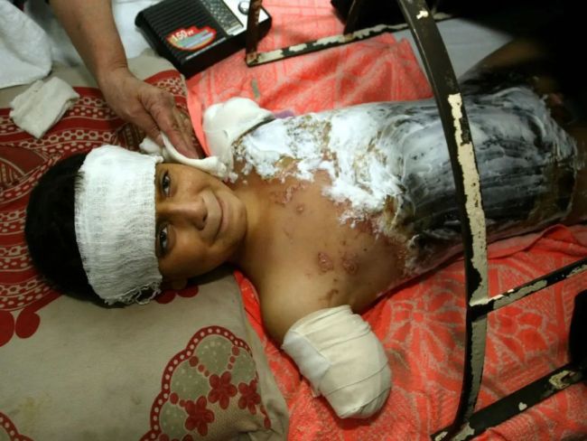 ▲2003年，伊拉克巴格达一名年仅12岁的儿童在美军的轰炸中失去了双臂。