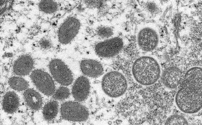 图为2003年感染猴痘病毒的皮肤组织切片