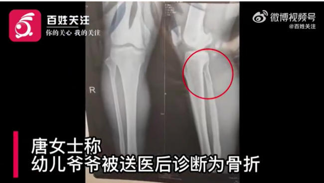 孩子被同学打伤家长上门掌掴5岁幼儿