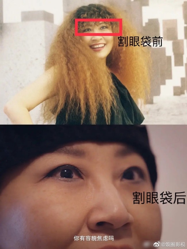 张蔷割眼袋失败喊话整容医生