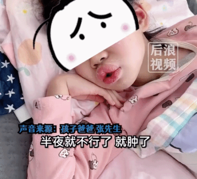 8岁女孩吃布洛芬过敏肿成香肠嘴，爸爸：烧也没怎么退