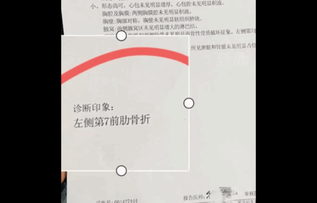 男子阳后连咳10多天把肋骨咳断！男子：哭笑不得