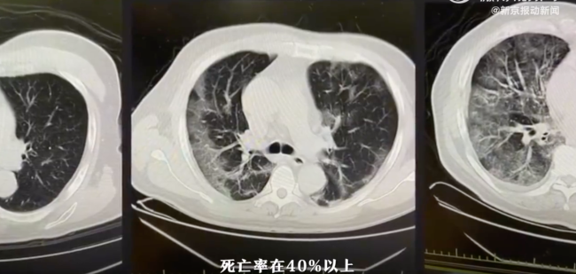 3分钟180秒拆解“白肺”六大疑问