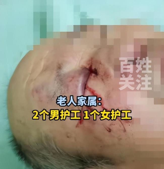 警方调查大连一老人被打 殴打导致眼球破裂右眼失明  