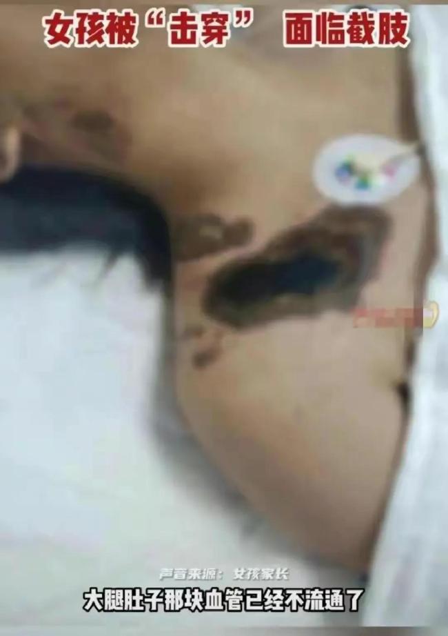 沈阳一女孩充电玩手机被电击，各脏器受损需要截肢