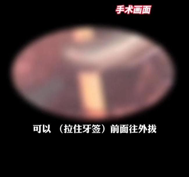 危险！深圳一男子吃烧烤吞下5厘米牙签，医生：再晚一点就没命了
