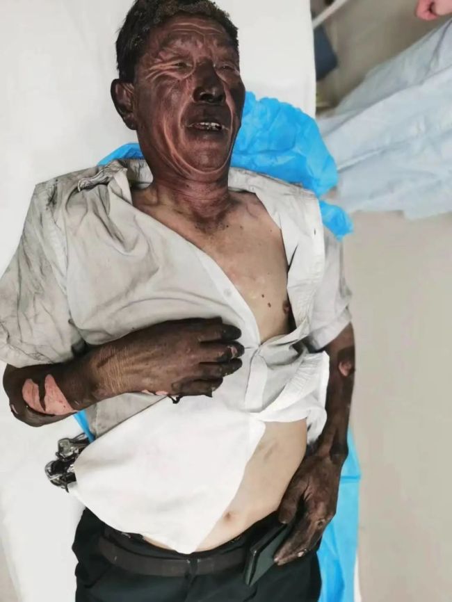 70岁保安冲入火场救火被灼成“雕像”，浑身上下裸露在外的皮肤一片漆黑