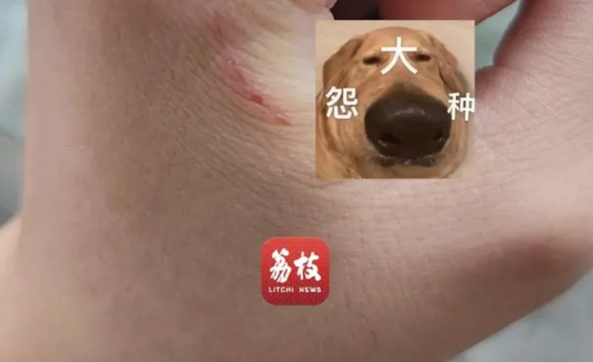 男生帮女朋友吸伤口确诊三级暴露：病毒暴露最高等级