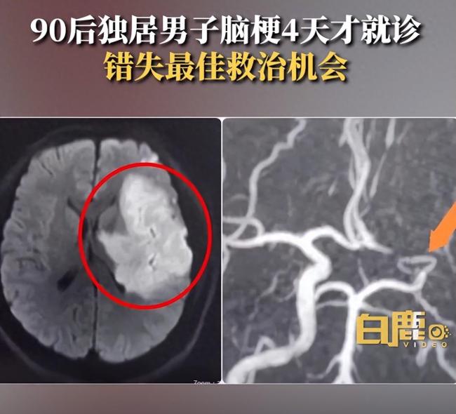 痛心！33岁独居男子脑梗4天才就诊，错失最佳救治机会