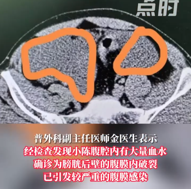 男子酒后憋尿摔倒致膀胱破裂被送进ICU