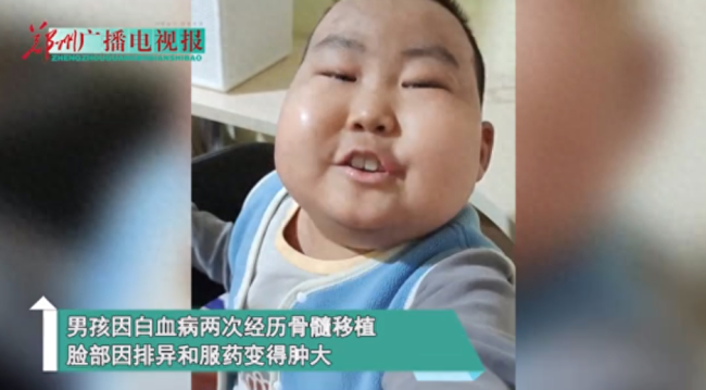 患病男孩肿成馒头脸仍笑对生活他说:“爱笑的人运气不会太差”