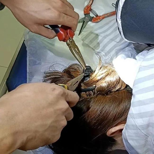 痛！浙江女子车祸，被这种发夹深深插进后脑头皮……消防用尖嘴钳、剪刀拆了几分钟才松开