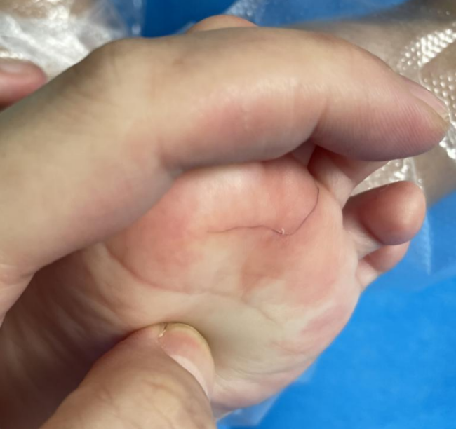 长沙半岁女婴哭闹不止 医生从脚底皮肤中取出4cm头发